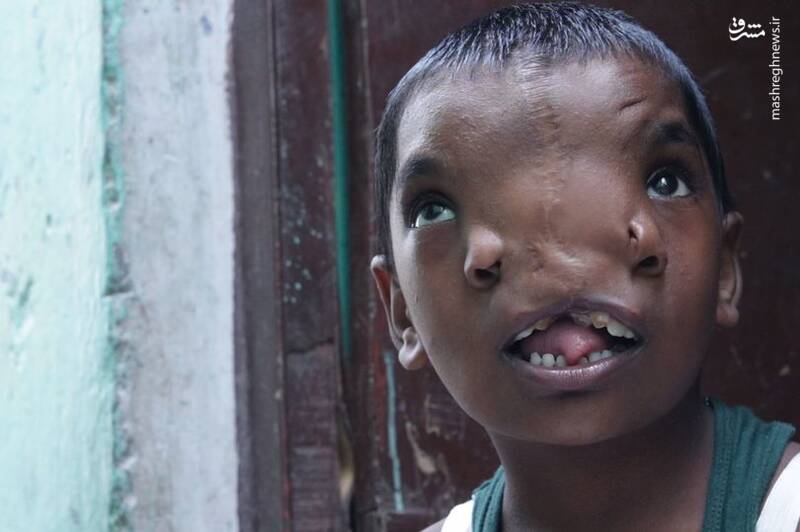 عکس/ دختر هندی با دو بینی