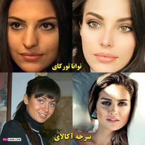 چهره قبل عمل زیبایی خانم بازیگران ترکیه ای / از هیلان تا هانده ارچل! + عکس های باورنکردنی